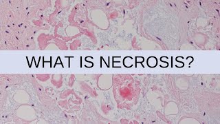 What is Necrosis  Pathology mini tutorial [upl. by Jeddy845]