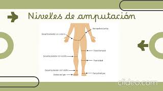 Fisioterapia en pacientes amputados [upl. by Carpenter]