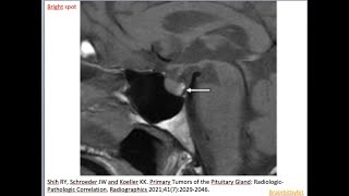 80 Posterior pituitary bright spot ectopic neurohypophysis oxytocin vasopressin endocrinology [upl. by Underwood]