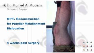 MPFL Reconstruction for Patellar Malalignment Dislocation  4 weeks post surgery [upl. by Jepum]