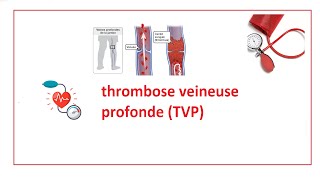 ❤thrombose veineuse profonde TVP [upl. by Aissac]