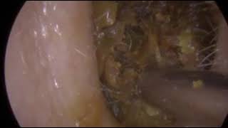 THE WAXBUSTER  AWESOME ENDOSCOPIC WAX REMOVAL [upl. by Ahseer]