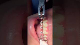 This Is Why Getting Braces Removed Is PAINLESS 😃🦷 [upl. by Martres]