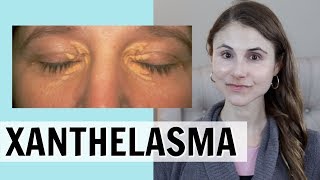 XANTHELASMA WHAT IT IS amp HOW IT IS TREATED DR DRAY [upl. by Lrac]