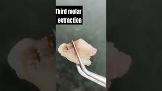 Third molar extraction wisdomtoothremoval extraction [upl. by Odnesor]