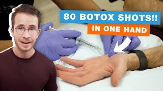 Sweaty Palms Is Botox the Ultimate Sweat Solution [upl. by Carce646]