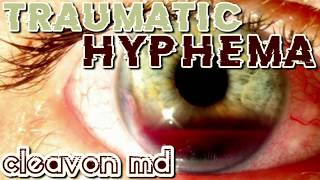 Cleavon MD  Traumatic Hyphema [upl. by Nahraf432]