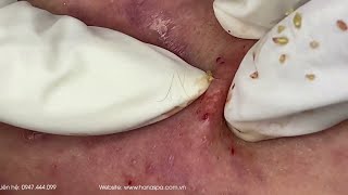 Big Cystic Acne Blackheads Extraction Blackheads amp Milia Whiteheads Removal Pimple Popping [upl. by Ettenyar]