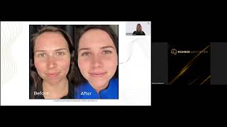 Rohrer Aesthetics  Mastering IPL Webinar [upl. by Aniaz428]