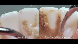 The impacts of ultrasonic insert tip wear  Dentsply Sirona [upl. by Aronson153]