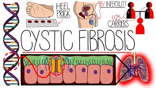 Understanding Cystic Fibrosis Includes Pathophysiology amp Diagnosis [upl. by Asilla]