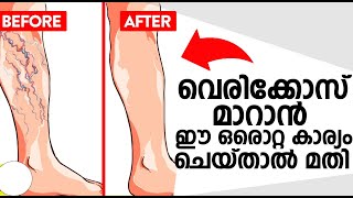 വെരികോസ് മാറാൻ ഈ ഒരൊറ്റ കാര്യം ചെയ്താൽ മതി  Varicose veins Malayalam [upl. by Elson]