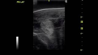 Dr Riccio  Low Frequency Ultrasound Treatment of Suspensory Ligament Branches Desmitis  Video 2 [upl. by Lika]