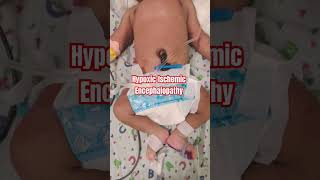 HypoxicIschemic Encephalopathy  what is HIE in newborn HIE seizures hypoxia [upl. by Jackqueline]