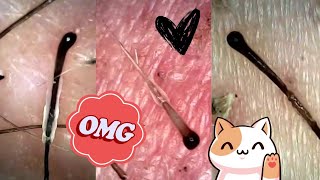 BIG amp JUICY ROOTS  Hair Follicle Plucks Very Satisfying Hair Removal Under Microscope [upl. by Saqaw]