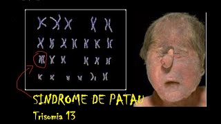 Síndrome de Patau Trisomía 13 [upl. by Aititel108]