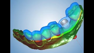 Implant Guide Designing in Planmeca Romexis [upl. by Torras]