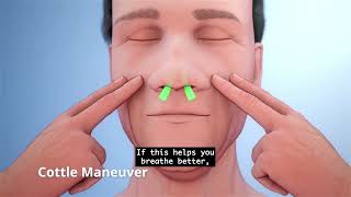 What is nasal airway obstruction NAO How can VivAer help English captions [upl. by Akimahs]