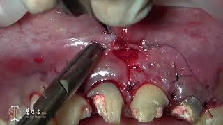 Recession Coverage via Soft Tissue Substitute Frenectomy amp Apicoectomy in Aesthetic Zone VII [upl. by Palua]