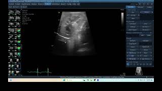 IQ 277 TFAST CAUDAL LOBE PULMONARY EDEMA ECHOPAC ANALYSIS ULTRASOUND [upl. by Tita100]