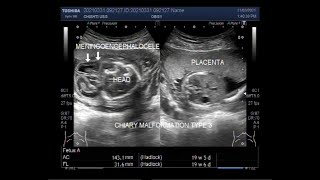 Chiari type 3 malformation with Meningoencephalocele [upl. by Pandich]