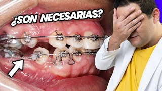 ¡La GUERRA de las EXTRACCIONES de PREMOLARES ¿SACAR DIENTES Es NECESARIO para tu TRATAMIENTO [upl. by Zolner]