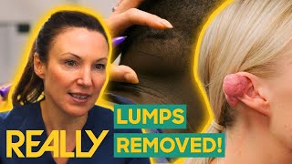 Dr Emma Removes Painful Lipoma and Keloid From The Neck And Ear  The Bad Skin Clinic [upl. by Bonita216]