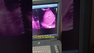 liver ultrasoundRight side pleural effusion ultrasound doctor youtubeshorts [upl. by Oruam548]