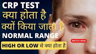 CRP test kya hota hai  crp test in hindi  crp test normal range  crp high hone se kya hota hai [upl. by Asilram]