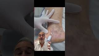 un traitement impressionnant des varicosités varices sclerotherapy doppler health santé [upl. by Litnahc925]