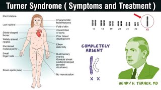 Turner Syndrome  monosomic disorder  symptoms and treatment of turner syndrome in Hindi [upl. by Seymour]