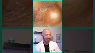 Doctor reacts to juicy cyst pop dermreacts doctorreacts pimplepop [upl. by Thayne]