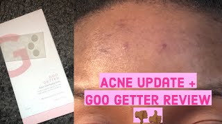 Goo Getter Zitsticka Review on my Acne  Forehead amp Skin Update  My 2021 New Year Skin Resolutions [upl. by Ellenyl78]