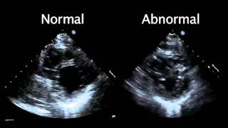 Echocardiogram from the Patient Compared with That from a Normal Control  NEJM [upl. by Willa696]