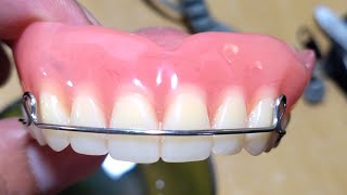 Pustiso with Retainer or Denture with Retainer [upl. by Htenaj799]