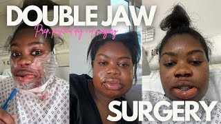 What its REALLY like having double jaw surgery  VLOG [upl. by Hardej]