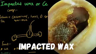 Impacted Ear Wax  Cerumen  And it’s Treatment [upl. by Monda14]