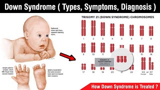 Down syndrome  types of down syndrome  symptoms treatment diagnosis in Hindi [upl. by Nnyl519]