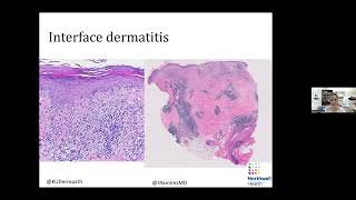 Global Dermatology Talks 11272023  Silvija Gottesman [upl. by Ayela999]