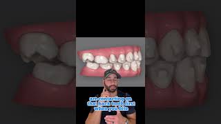 Invisalign And Teeth Grinding Why you shouldn’t be quick to get veneers [upl. by Anyd575]