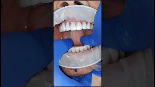 graphene dental full arch dental implant bridges for basal dental implants durable prostheis [upl. by Drew]