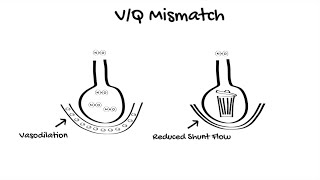 Inhaled Nitric Oxide in ICU [upl. by Rudiger735]