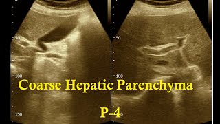 Coarse Hepatic Parenchymal  HBS Format  Amader hospital  আমাদের হাসপাতাল  Ultrasonography report [upl. by Loginov]