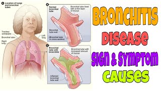 Bronchitis treatment Bronchitis cough and sound [upl. by Hoang]