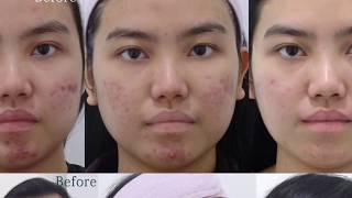 Lutronic Spectra amp Gold Toning Laser Treating Acne amp Redness at BeauampHans Aesthetic [upl. by Kalinda]