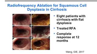 Progress in the Treatment of Squamous Esophageal Dysplasia and EarlyStage Cancer [upl. by Llehsyt]