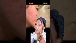 Best solution for Acne and Acne marks ‼️😱acne acnetreatment acnemark acnescars e [upl. by Ielak]