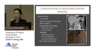 Revisional Bariatric Surgery How Bad Can It Be [upl. by Hola834]