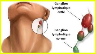 L’inflammation des ganglions lymphatiques  quelle en est la cause [upl. by Eitsyrk]