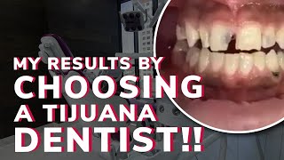 😱 MY HONEST OPINION COMING FOR VENEERS IN TIJUANA MEXICO 🤔 XDentistry Reviews [upl. by Komarek]